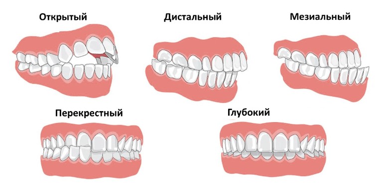 Правильный прикус у человека схема как определить